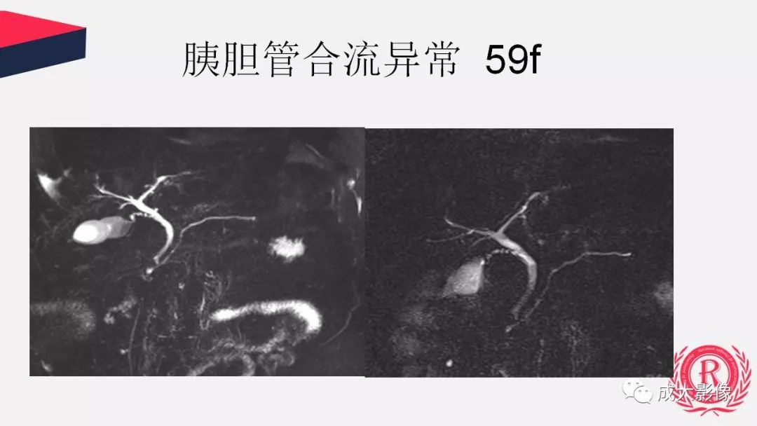影像PPT - 【PPT】胰腺变异影像学诊断-23