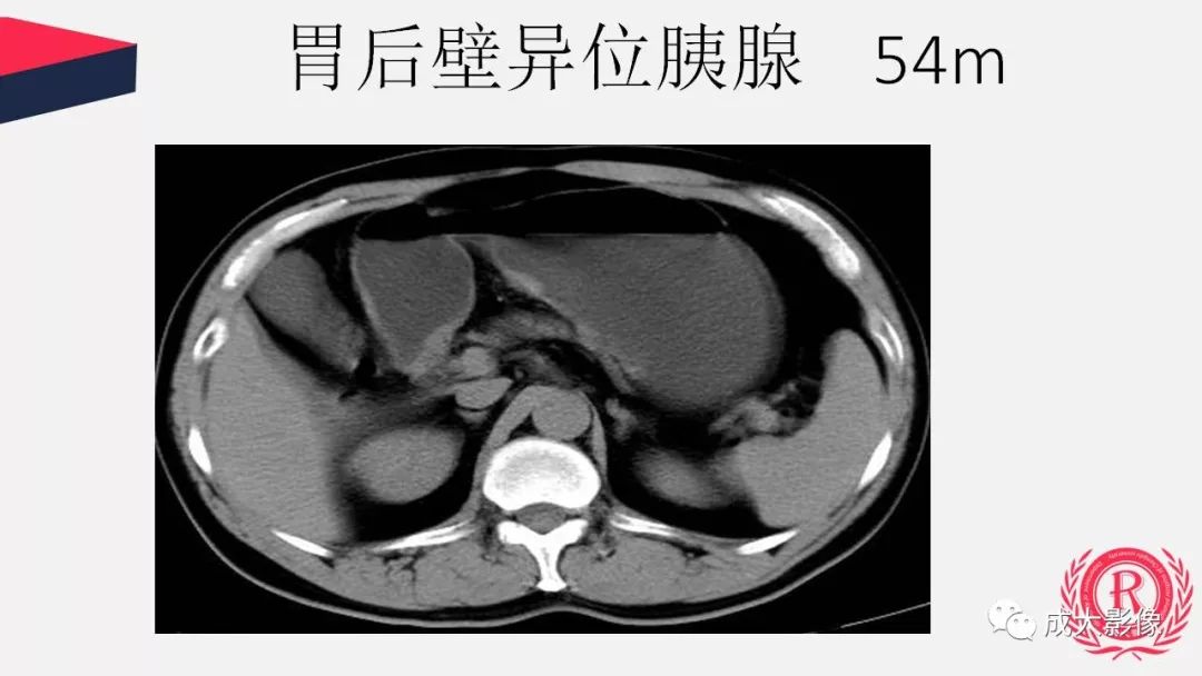 影像PPT - 【PPT】胰腺变异影像学诊断-44