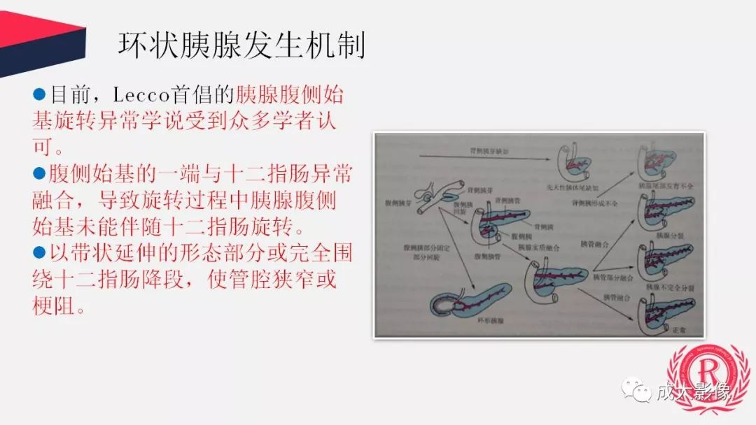 影像PPT - 【PPT】胰腺变异影像学诊断-28