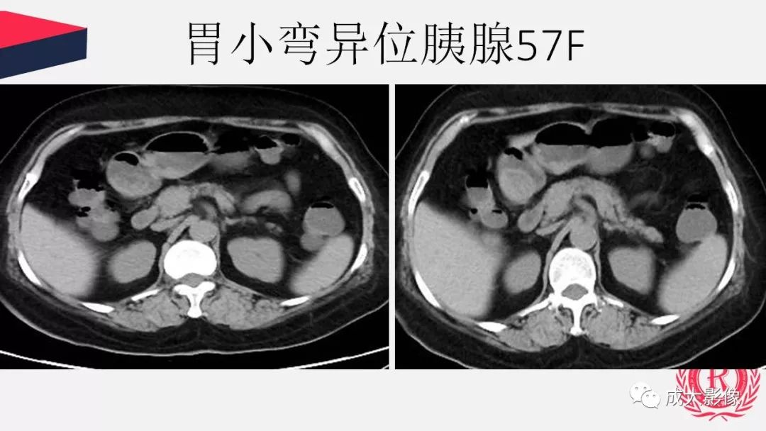 影像PPT - 【PPT】胰腺变异影像学诊断-47