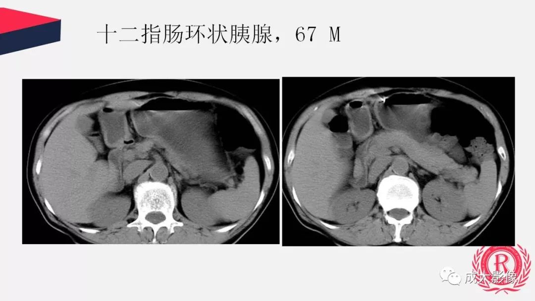 影像PPT - 【PPT】胰腺变异影像学诊断-32