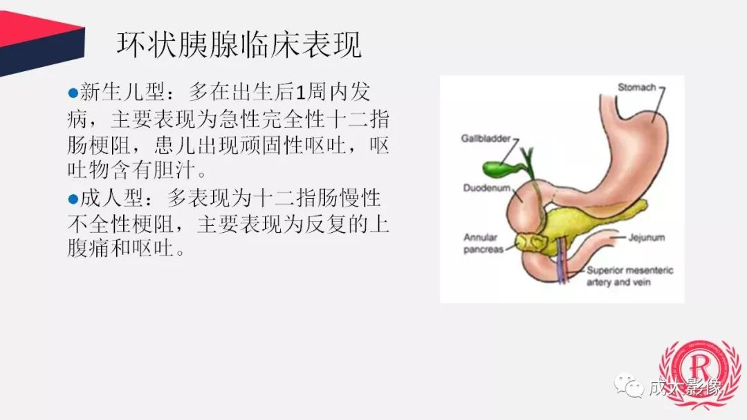 影像PPT - 【PPT】胰腺变异影像学诊断-29