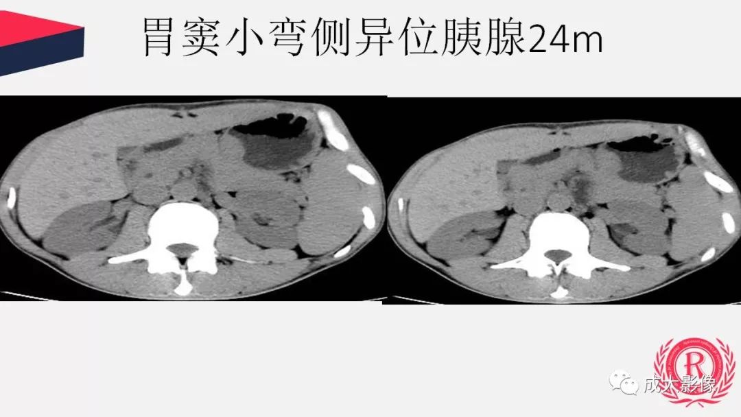 影像PPT - 【PPT】胰腺变异影像学诊断-50