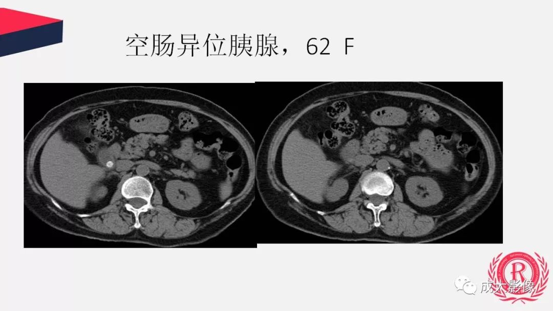 影像PPT - 【PPT】胰腺变异影像学诊断-54