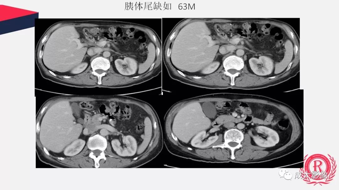 影像PPT - 【PPT】胰腺变异影像学诊断-57