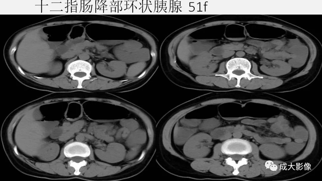 影像PPT - 【PPT】胰腺变异影像学诊断-38