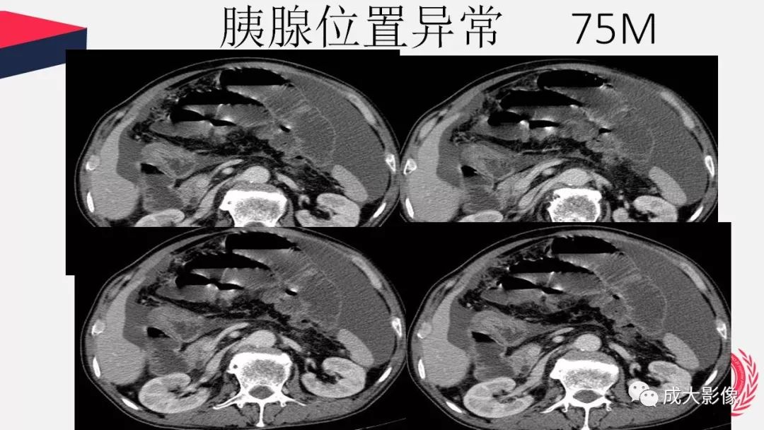 影像PPT - 【PPT】胰腺变异影像学诊断-63