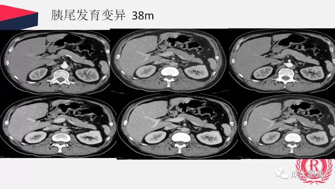 影像PPT - 【PPT】胰腺变异影像学诊断-66