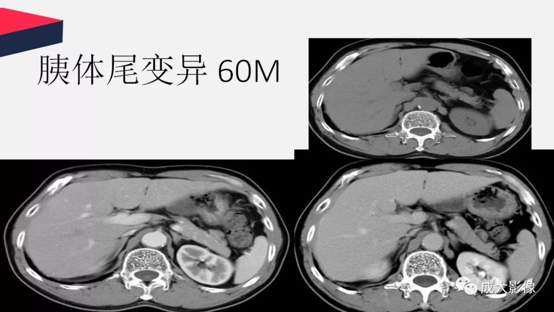 影像PPT - 【PPT】胰腺变异影像学诊断-69