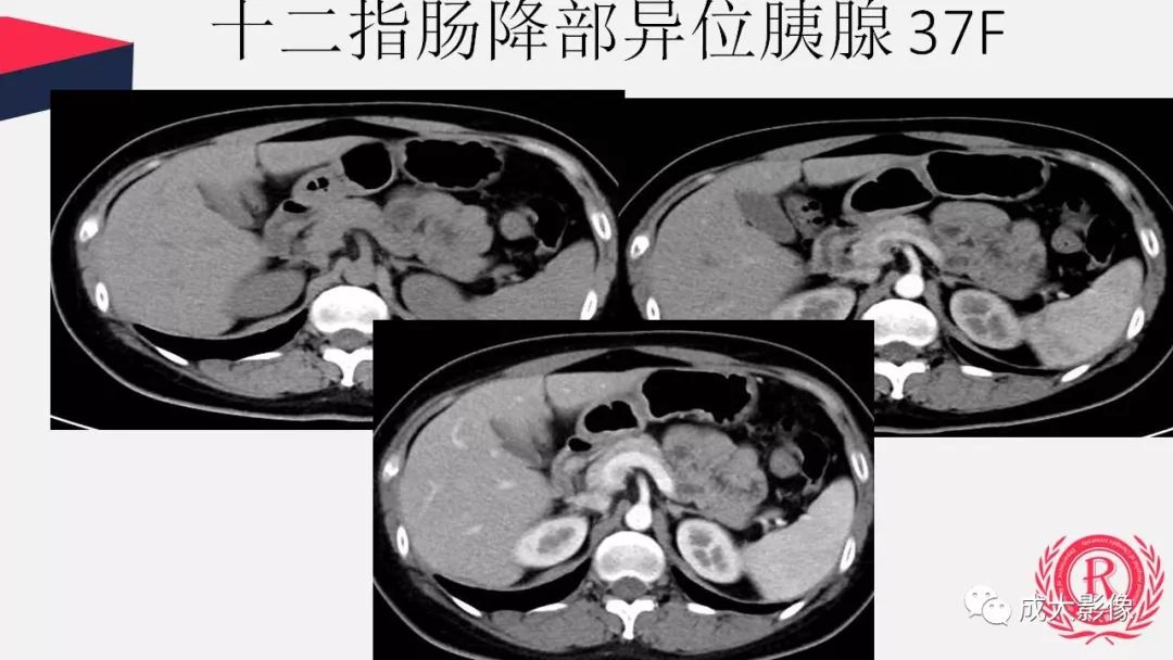 影像PPT - 【PPT】胰腺变异影像学诊断-53