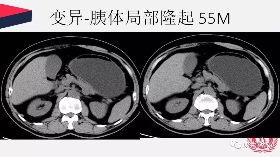 影像PPT - 【PPT】胰腺变异影像学诊断-74