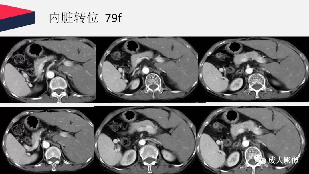 影像PPT - 【PPT】胰腺变异影像学诊断-61