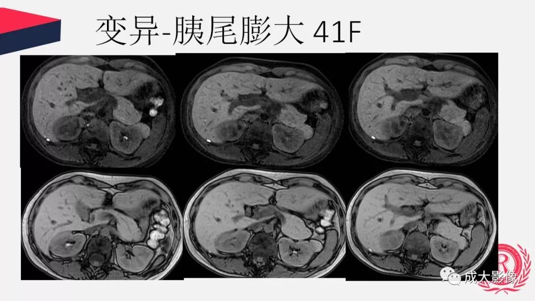 影像PPT - 【PPT】胰腺变异影像学诊断-76