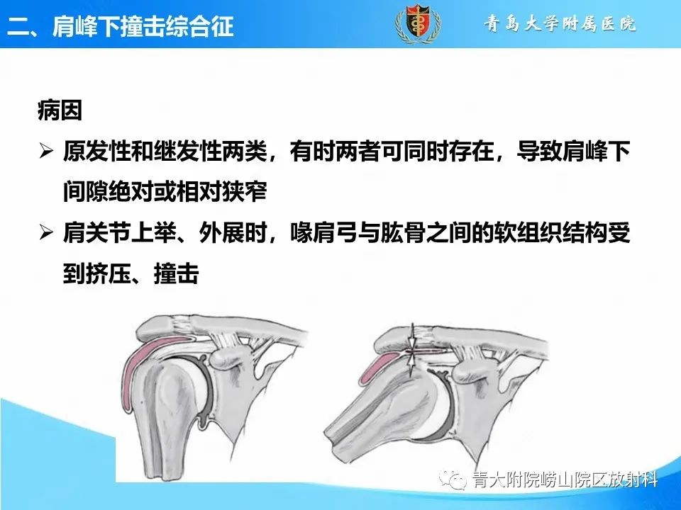 影像PPT - 【PPT】肩关节撞击综合征的影像评估-7