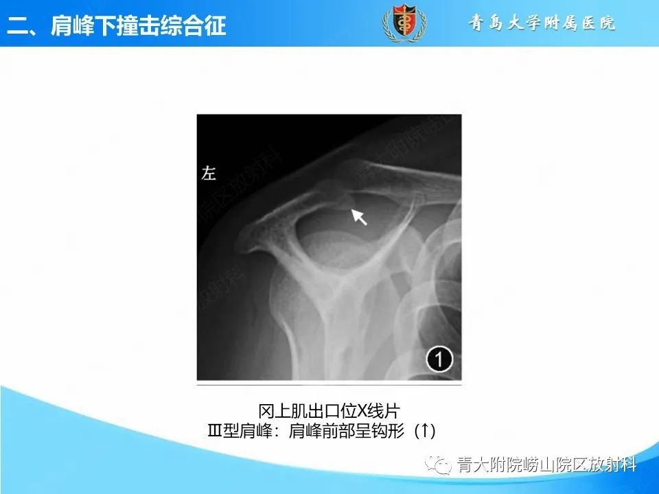 影像PPT - 【PPT】肩关节撞击综合征的影像评估-16
