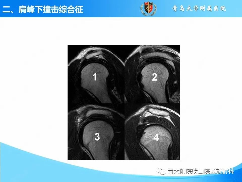 影像PPT - 【PPT】肩关节撞击综合征的影像评估-15