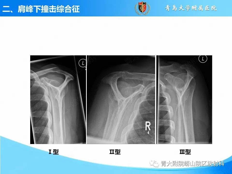 影像PPT - 【PPT】肩关节撞击综合征的影像评估-14
