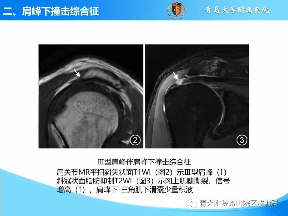 影像PPT - 【PPT】肩关节撞击综合征的影像评估-17