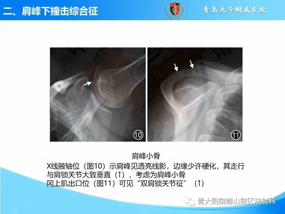 影像PPT - 【PPT】肩关节撞击综合征的影像评估-22