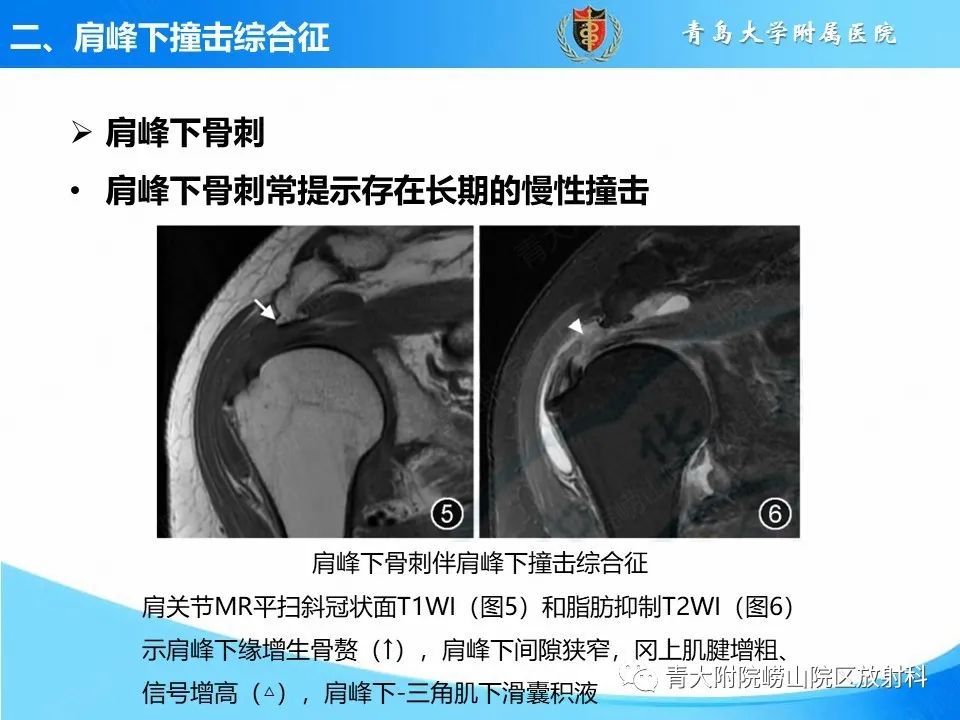 影像PPT - 【PPT】肩关节撞击综合征的影像评估-19