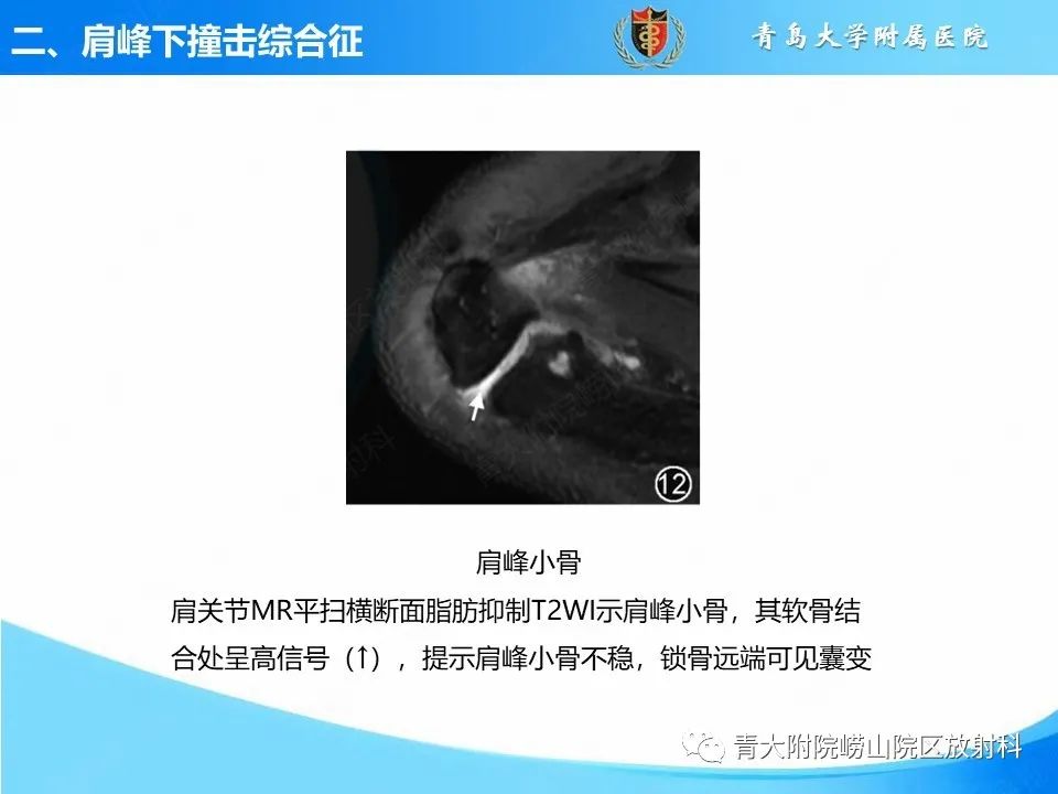 影像PPT - 【PPT】肩关节撞击综合征的影像评估-23