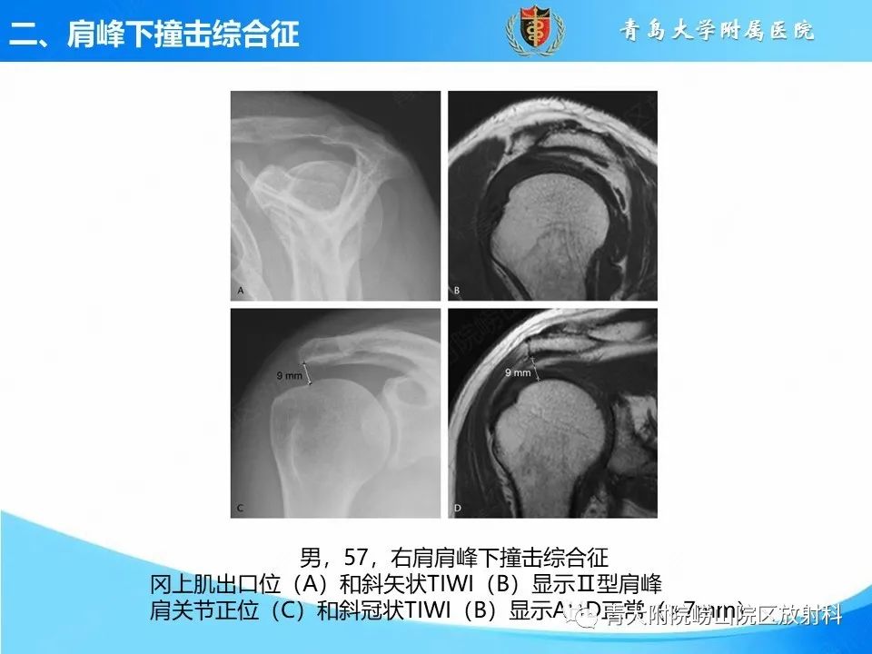 影像PPT - 【PPT】肩关节撞击综合征的影像评估-28