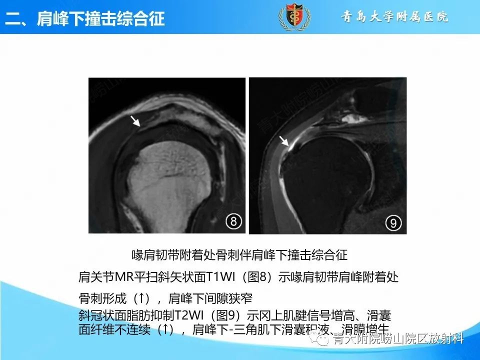 影像PPT - 【PPT】肩关节撞击综合征的影像评估-26