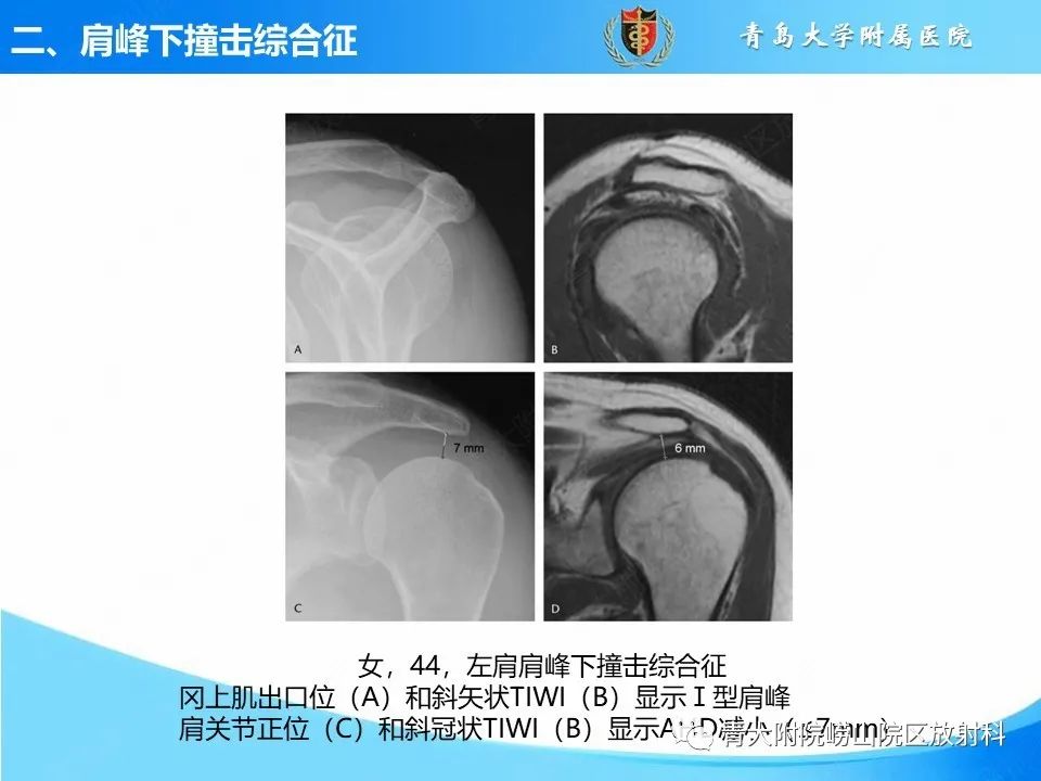 影像PPT - 【PPT】肩关节撞击综合征的影像评估-29