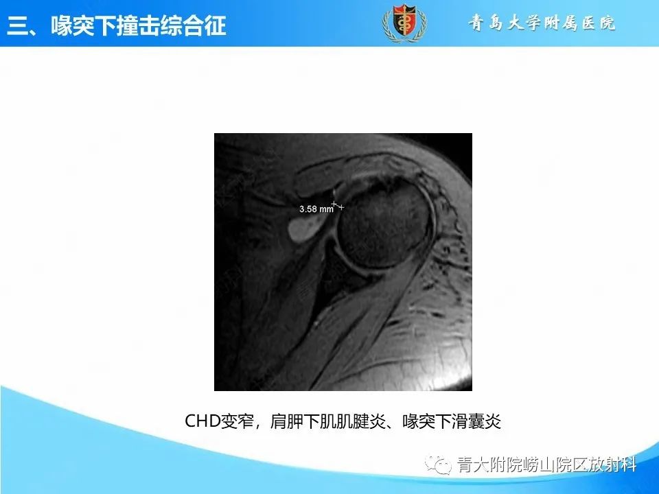 影像PPT - 【PPT】肩关节撞击综合征的影像评估-35