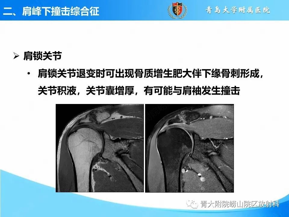 影像PPT - 【PPT】肩关节撞击综合征的影像评估-24