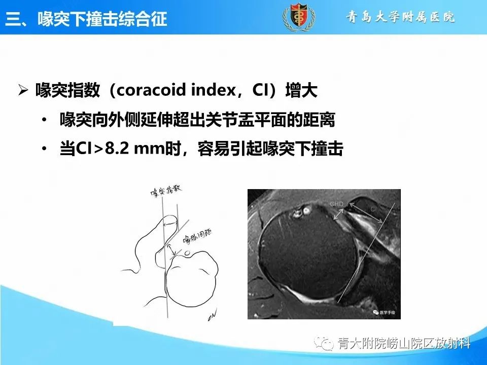 影像PPT - 【PPT】肩关节撞击综合征的影像评估-36