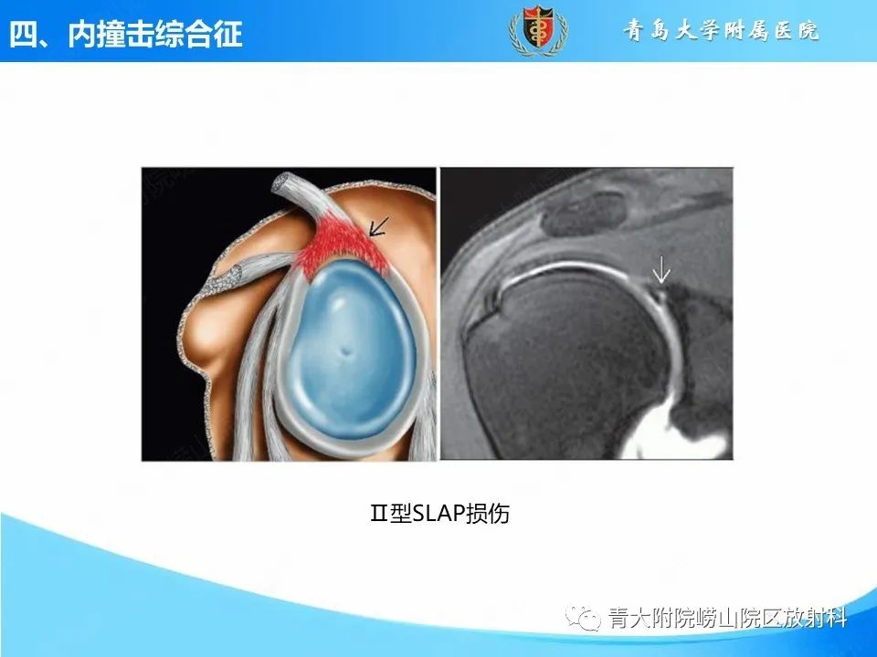 影像PPT - 【PPT】肩关节撞击综合征的影像评估-41