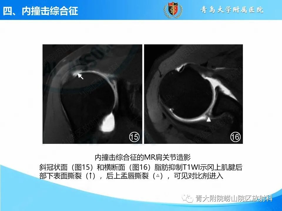 影像PPT - 【PPT】肩关节撞击综合征的影像评估-42