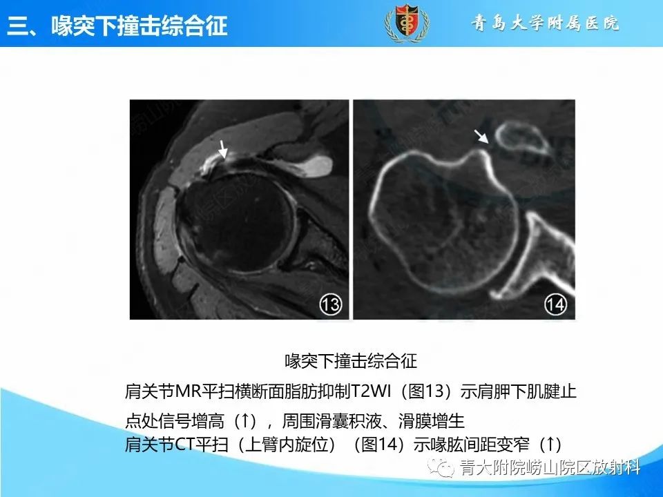 影像PPT - 【PPT】肩关节撞击综合征的影像评估-37