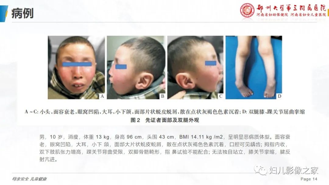 影像PPT - 【病例】cockayne综合征1例影像诊断-14