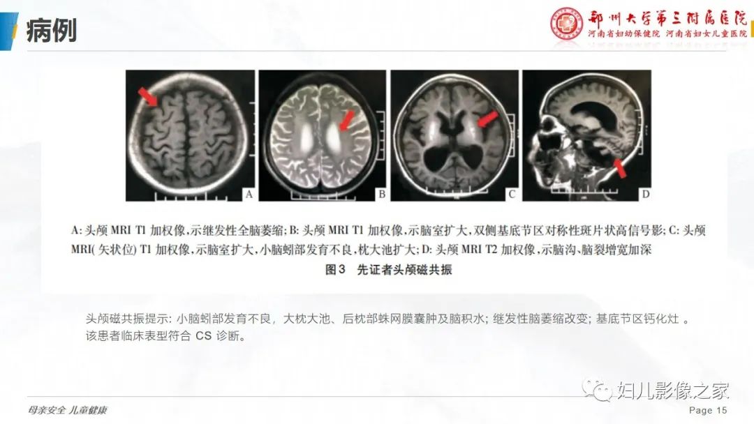影像PPT - 【病例】cockayne综合征1例影像诊断-15