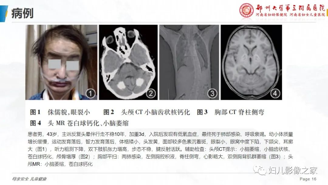 影像PPT - 【病例】cockayne综合征1例影像诊断-16