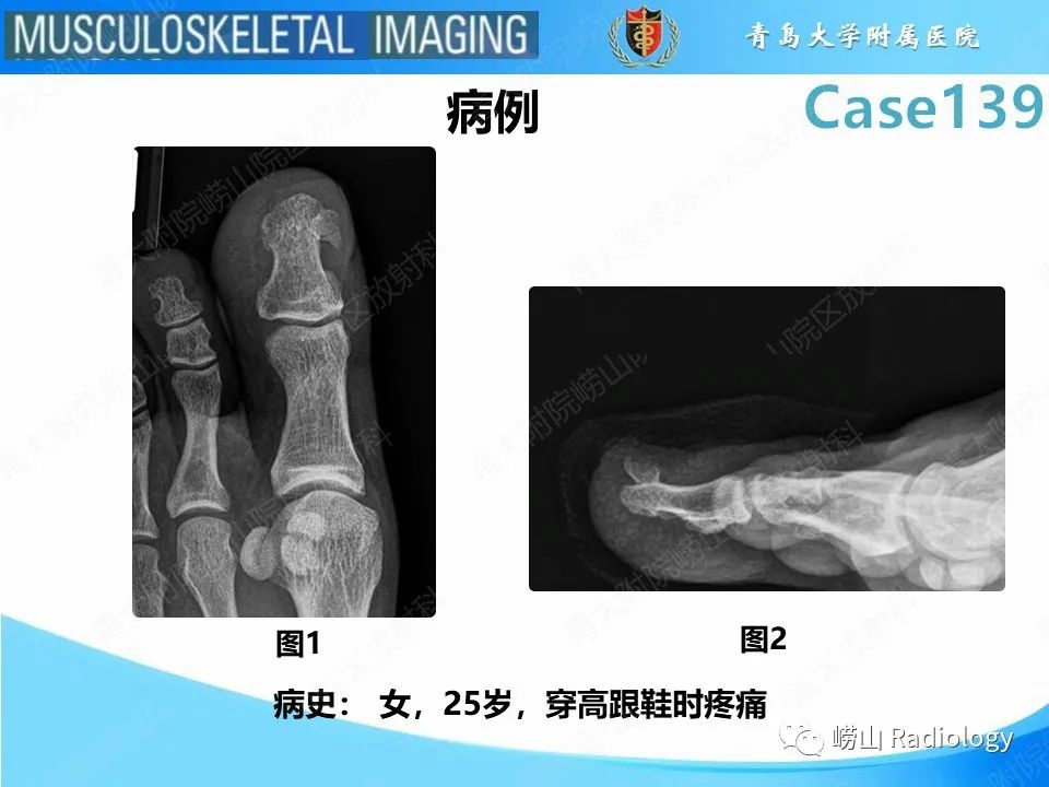 影像PPT - 【PPT】甲下外生性骨疣-2