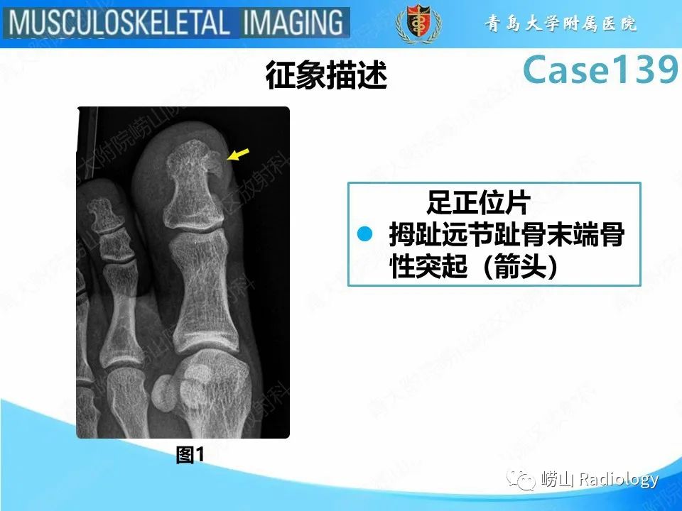 影像PPT - 【PPT】甲下外生性骨疣-11