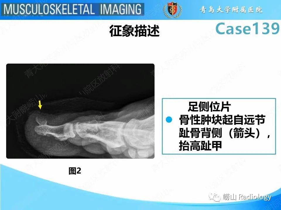 影像PPT - 【PPT】甲下外生性骨疣-12
