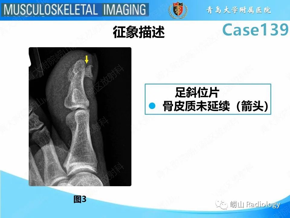 影像PPT - 【PPT】甲下外生性骨疣-13