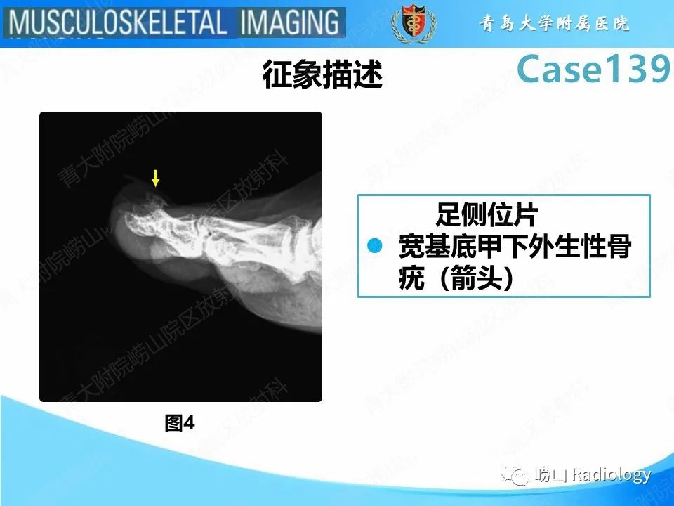 影像PPT - 【PPT】甲下外生性骨疣-14