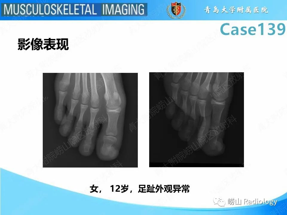 影像PPT - 【PPT】甲下外生性骨疣-17