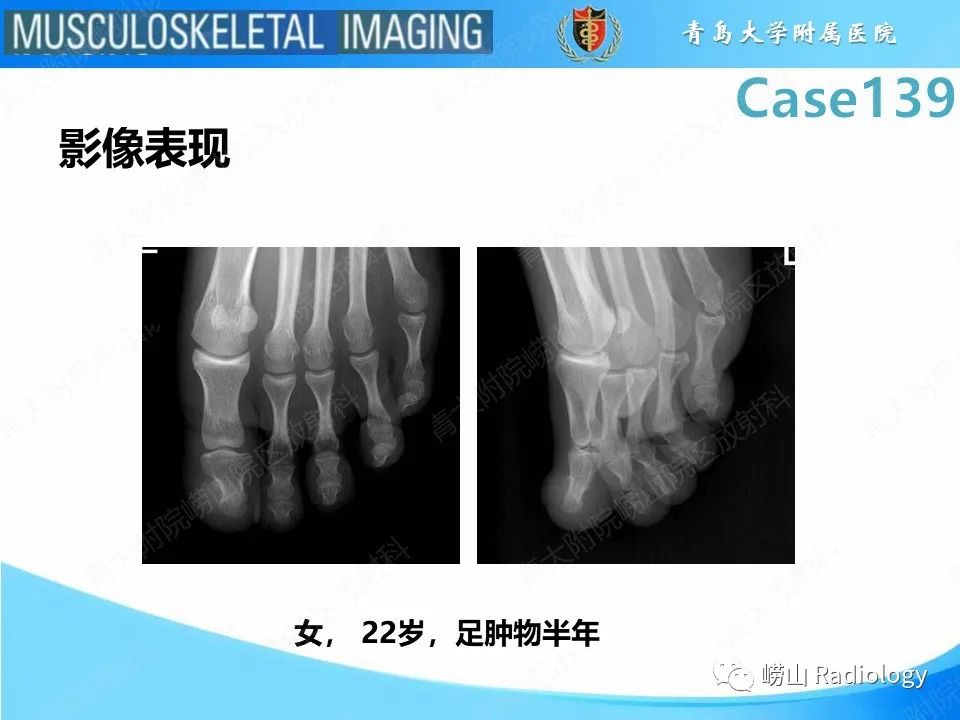 影像PPT - 【PPT】甲下外生性骨疣-18