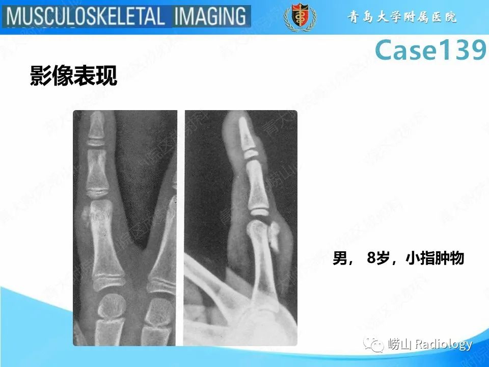 影像PPT - 【PPT】甲下外生性骨疣-20