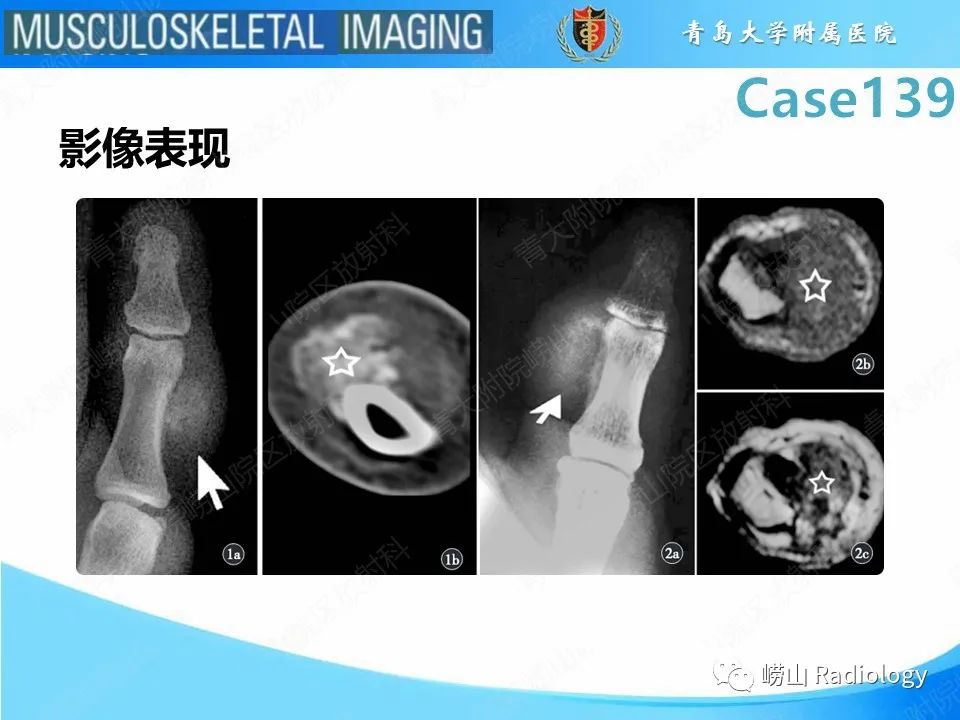 影像PPT - 【PPT】甲下外生性骨疣-22