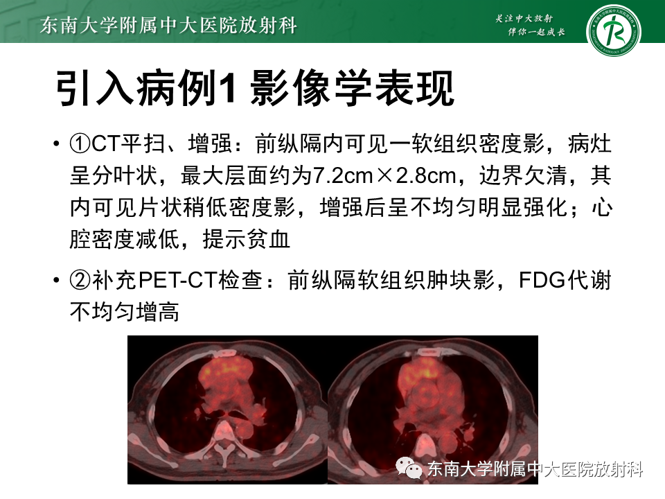 影像PPT - 【PPT】胸腺瘤-3 影像PPT - 【PPT】胸腺瘤-3