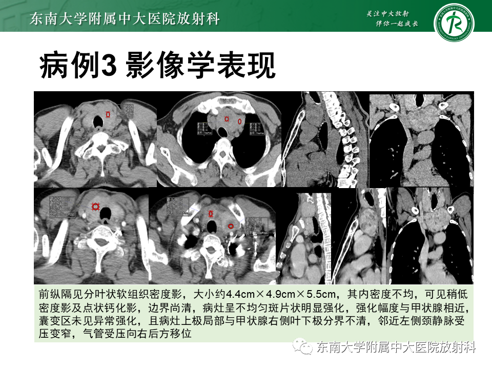 影像PPT - 【PPT】胸腺瘤-20 影像PPT - 【PPT】胸腺瘤-20