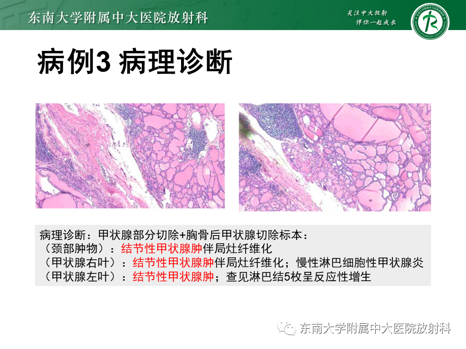 影像PPT - 【PPT】胸腺瘤-21 影像PPT - 【PPT】胸腺瘤-21