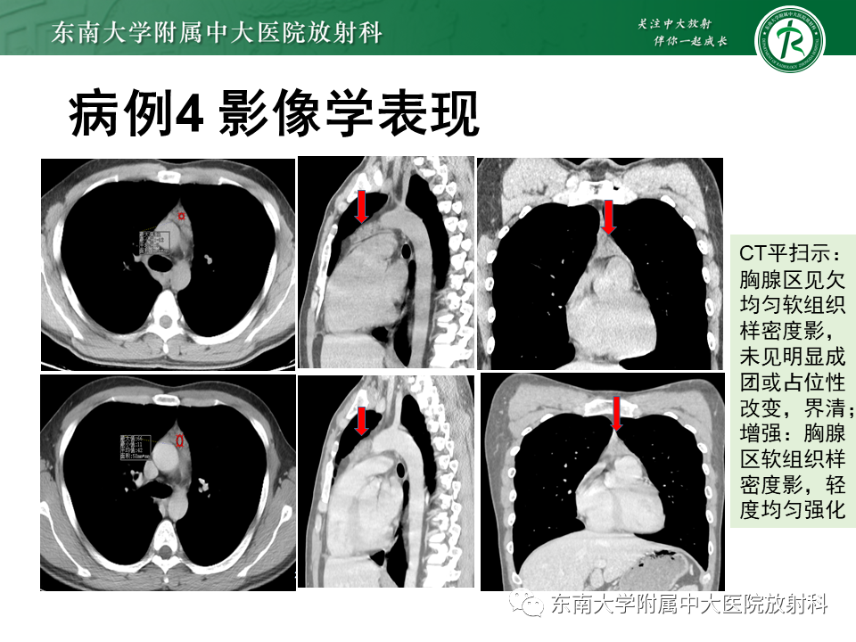 影像PPT - 【PPT】胸腺瘤-26 影像PPT - 【PPT】胸腺瘤-26